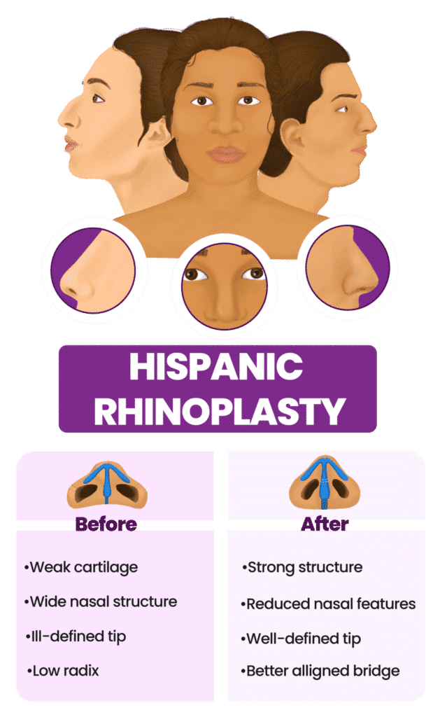 Hispanic rhinoplasty