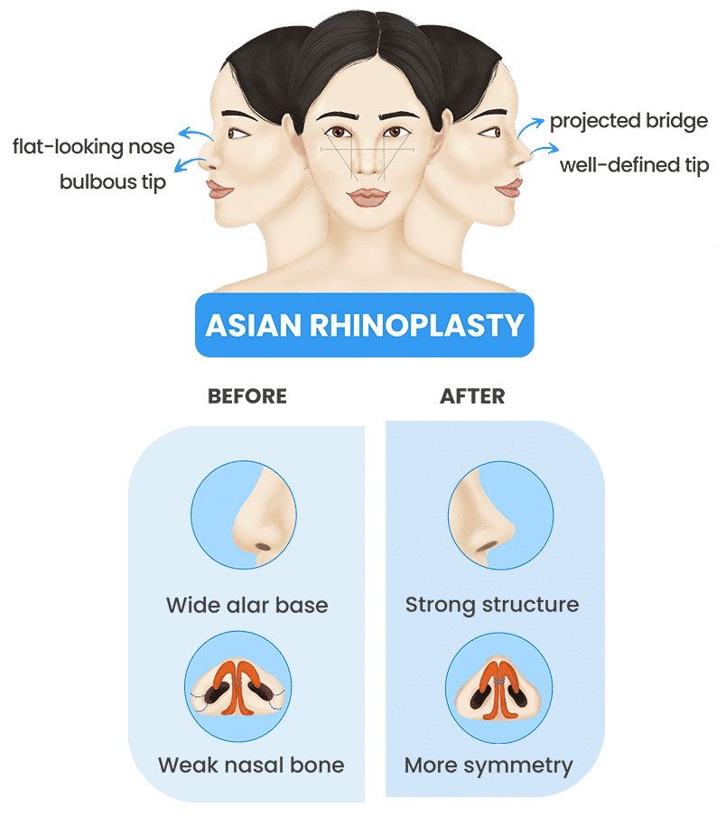 Asian rhinoplasty