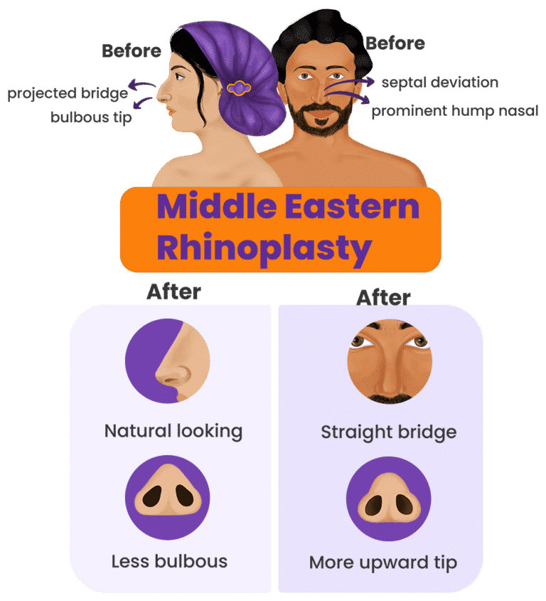 Middle Eastern Ethnic Rhinoplasty