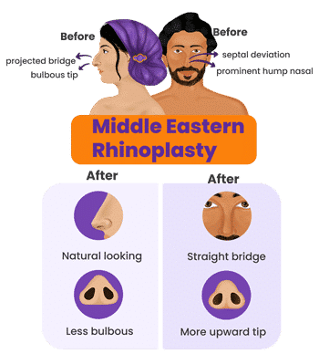 Middle Eastern Ethnic Rhinoplasty