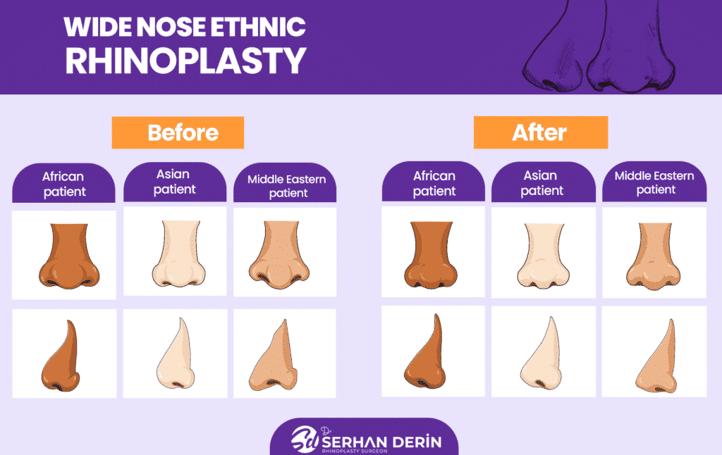 Wide nose ethnic rhinoplasty