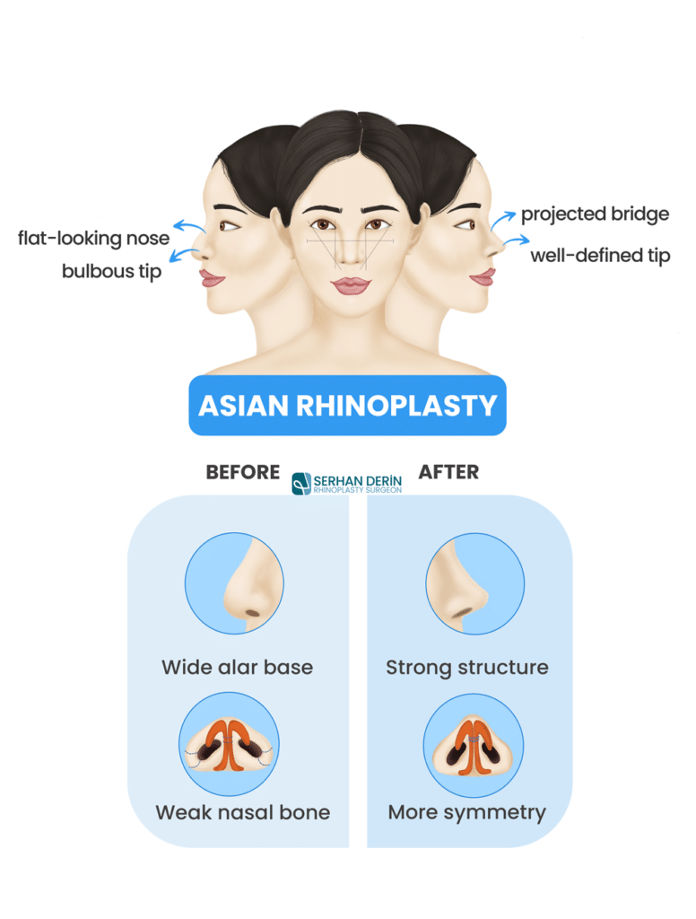 asian rhinoplasty, asian nose jobs, ethnic asian rhinoplasty, dr serhan derin asian nose