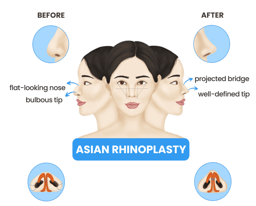 Asian rhinoplasty