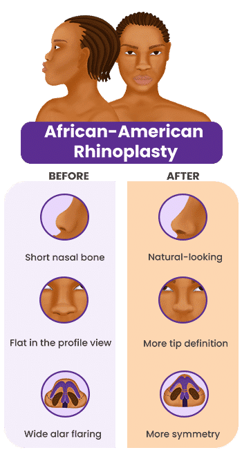 African american rhinoplasty