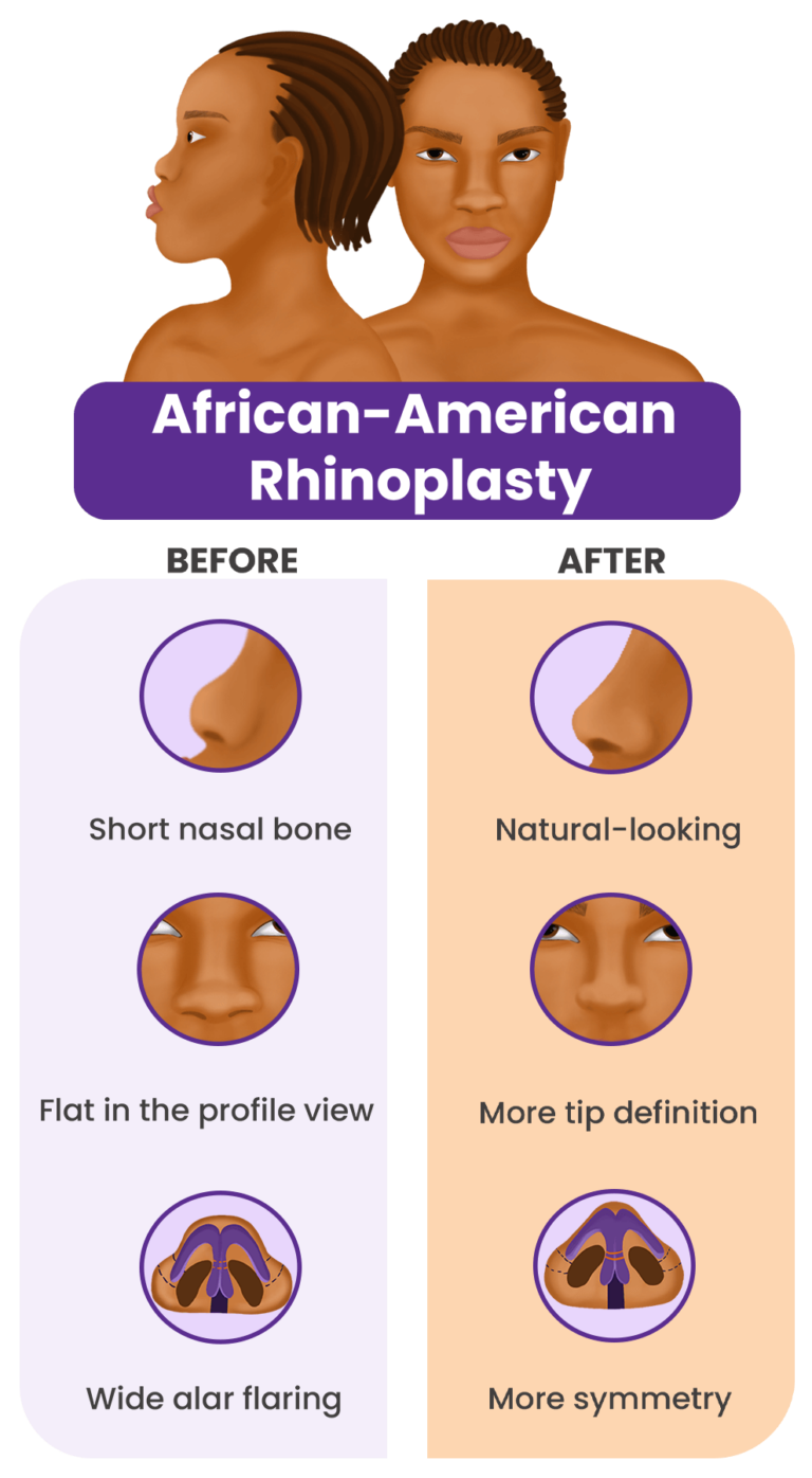 African American Ethnic Rhinoplasty