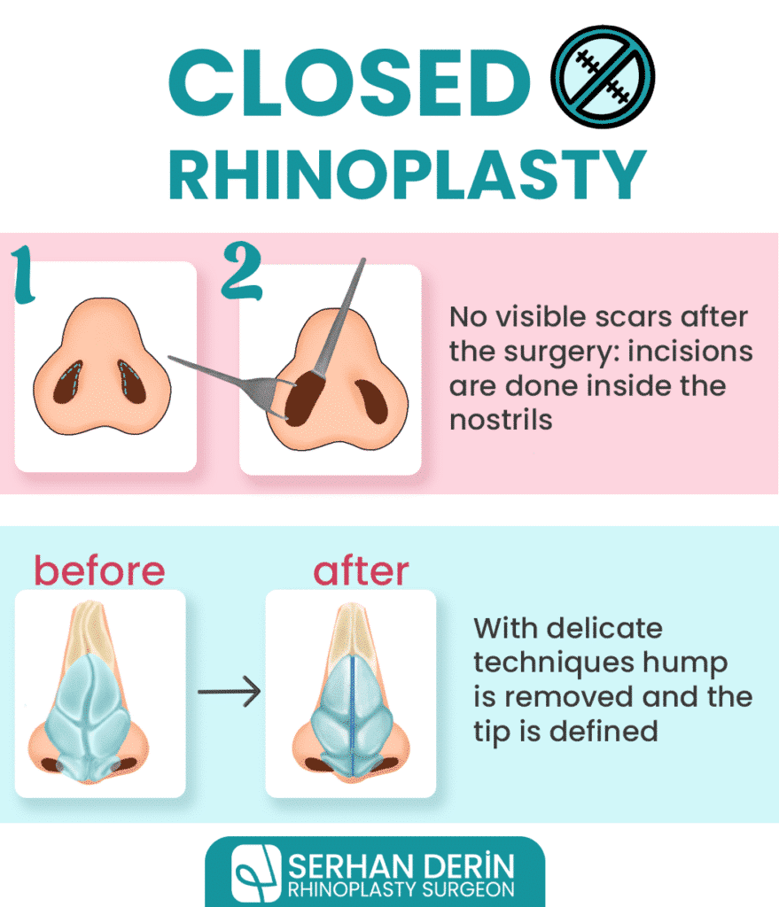 closed rhinoplasty