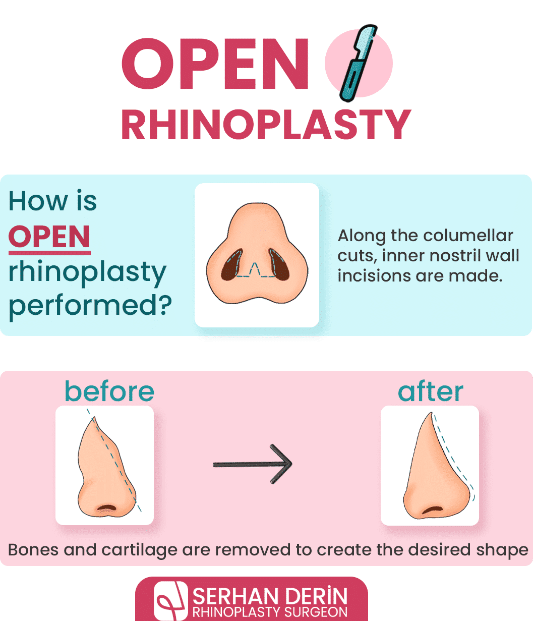 open rhinoplasty