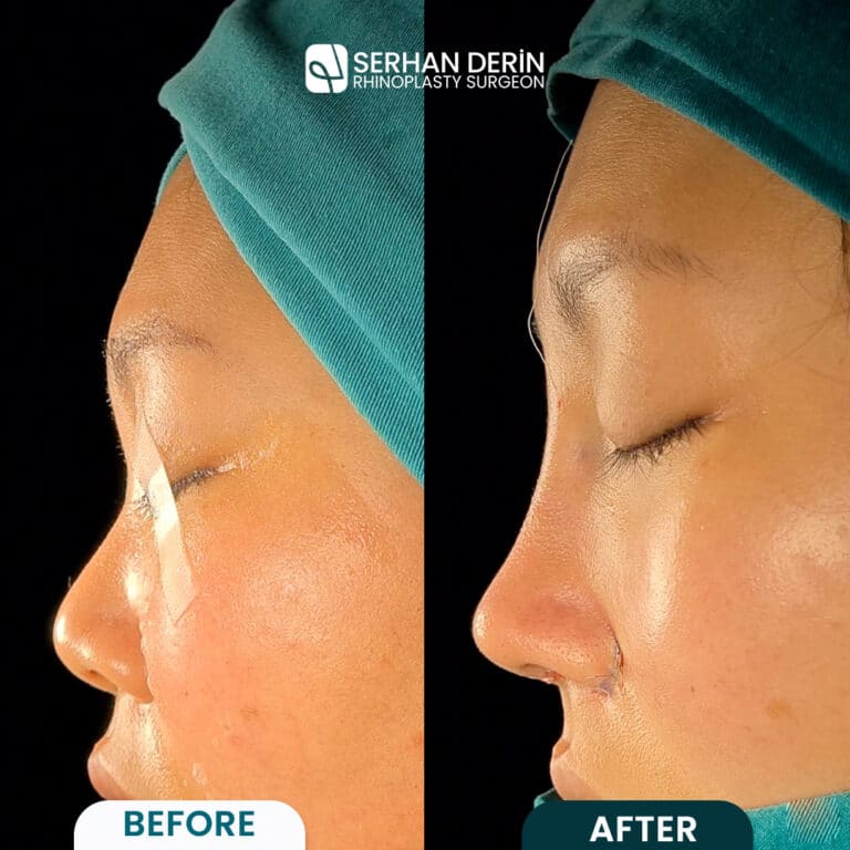 asian rhinoplasty before and after, asian nose job befor after photos, dr serhan derin before and after rhinoplasty