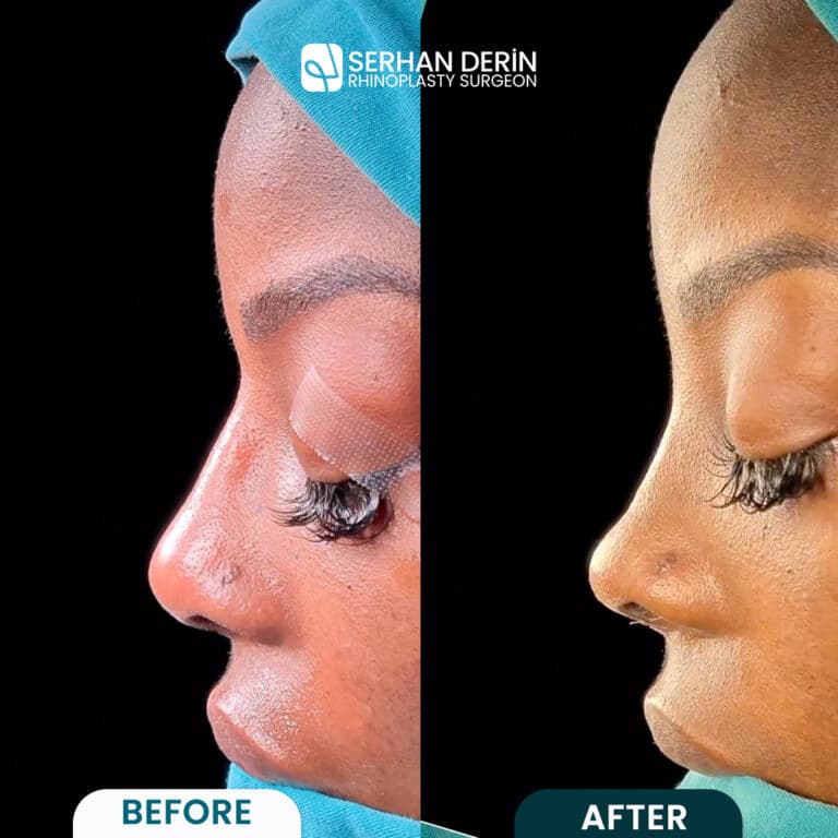 african american rhinoplasty before and after, african american nose job befor after photos, dr serhan derin before and after rhinoplasty