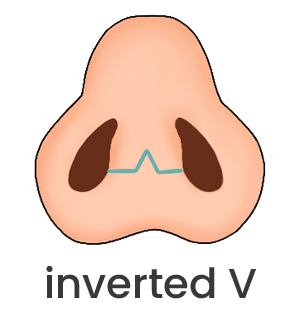 open rhinoplasty incision, incision type rhinoplasty